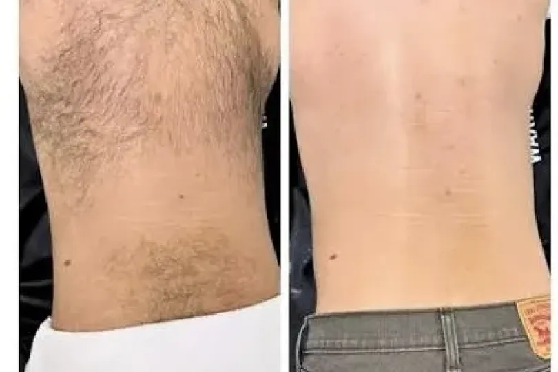 Waxing-Haarentfernung, Switzerland